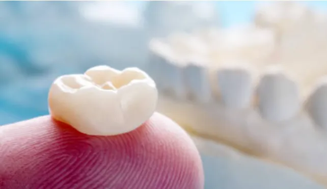 Diagram of a dental crown that has separated from the underlying tooth root