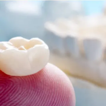 Diagram of a dental crown that has separated from the underlying tooth root
